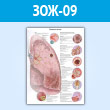 Плакат «Болезни легких» (ЗОЖ-09, пластик 2 мм, A2, 1 лист)
